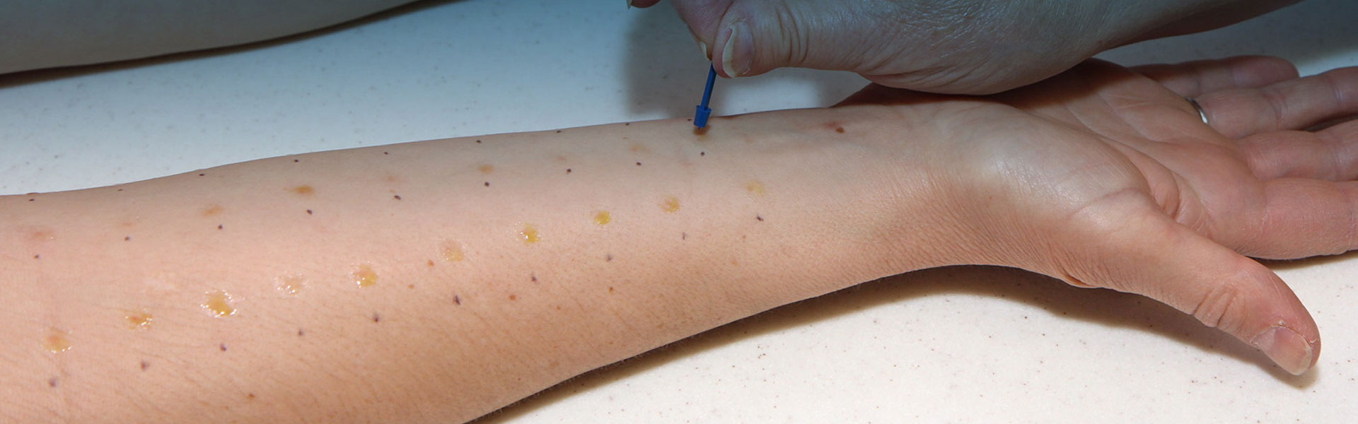 Allergy Skin Testing Banner image for Redding Allergy & Asthma Specialists | Atlanta Allergists